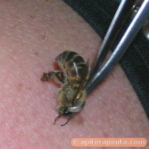 picadura de abeja en apiterapia HD